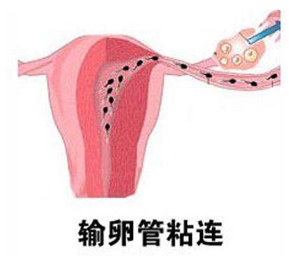 输卵管粘连会导致女性不孕吗
