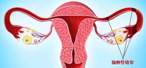 单侧输卵管不通的病因有哪些